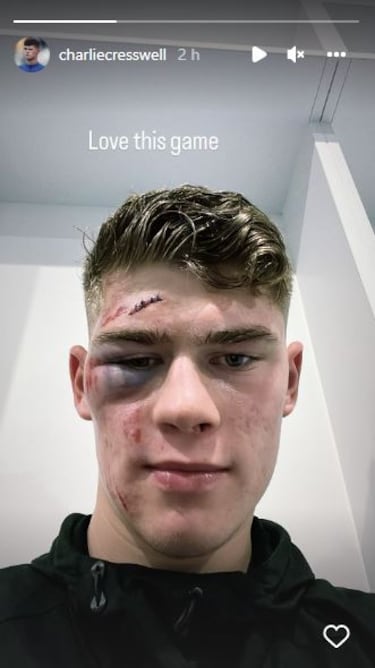 Estupiñán, expulsado por durísimo golpe a Charlie Cresswell