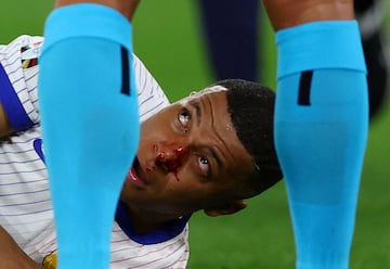 Lesión en la nariz del jugador francés, Kylian Mbappé.
