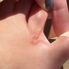 Así es el “gusano vivo” que tiene Lucía Pombo dentro del pie y que crece diariamente