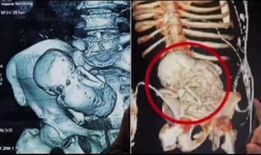 El caso de una mujer de 82 años que llevó dentro a su hijo durante 46 años sigue asombrando a la medicina