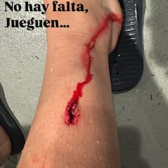 Prados, muy dolido, se suma a la lista de lesionados del Athletic