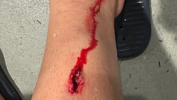 Prados, muy dolido, se suma a la lista de lesionados del Athletic