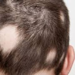 Baricitinib, la ‘pastilla milagrosa’ contra ciertas alopecias graves