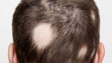 alopecia areata