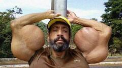 Imagen de Valdir Segato, conocido como el 'Hulk brasileño', posando con sus bíceps en los que inyectó synthol.