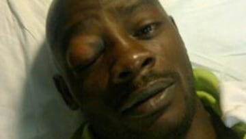 Emaná, baja tres semanas por una fractura del tabique