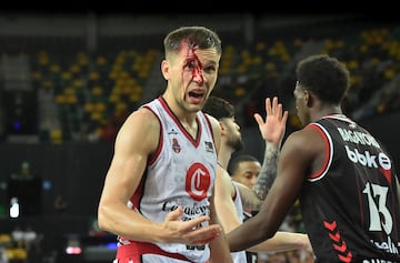 18/05/25 PARTIDO BALONCESTO ACB ENDESA
BILBAO BASKET - CASADEMONT ZARAGOZA
LESION BRECHA SANGRE