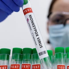 Viruela del mono en México: casos confirmados y qué se sabe