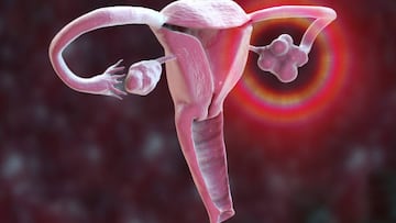 Polycystic ovary syndrome. Computer illustration showing a healthy ovary (right) and an enlarged ovary with cysts (left).
