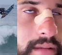 El campeón olímpico se rompe la nariz con su propia tabla de surf