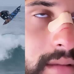 El campeón olímpico se rompe la nariz con su propia tabla de surf