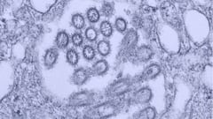¿Qué es el virus de Marburgo? Síntomas, consecuencias y tratamientos.