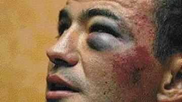 <b>Lo peor es el edema.</b> n Germán Nieto (, que esperó a los accidentados, conduce a Blanco y Burgos, que perdieron 6:37 en meta. Maestre quedó descolgado y cedió 7:38. Según explicó el doctor Fernando Astorki, médico de la Vuelta, lo peor para Blanco no es la fractura del pómulo, sino el edema en el ojo, que le va impedir la visión.