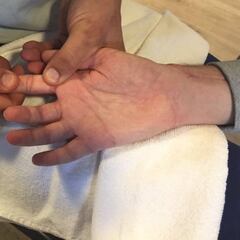 Se revela el aspecto de la mano derecha de Bruno Hortelano