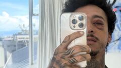 Nyjah Huston se fractura el cráneo y casi pierde un ojo