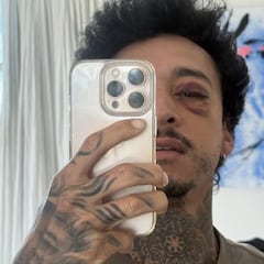 Nyjah Huston se fractura el cráneo y casi pierde un ojo