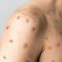 Viruela del mono: lo que se sabe de las primeras muertes en el mundo por esta enfermedad