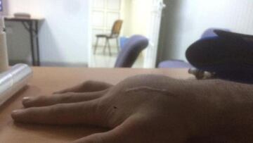 La mano de Petrucci antes de ser intervenido.