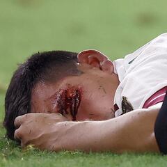 Lozano suffers serious injury in Mexico draw with Soca Warriors