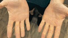 Florida man goes on extreme meat and fat diet for 8 months and suffers shocking side effects