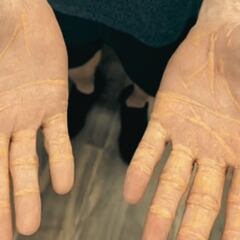 Florida man goes on extreme meat and fat diet for 8 months and suffers shocking side effects