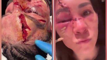 Imágenes muy sensibles: el terrible puñetazo que dejó a esta luchadora así de afectada