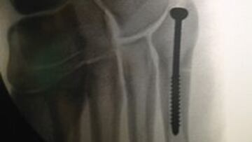 Xabi Alonso lleva un clavo de titanio en su pie derecho