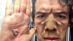 Rigo Urán mostró los rigores del pavé en una de sus manos