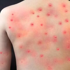 Viruela del Mono: OMS difunde nuevas recomendaciones ante alza de contagios