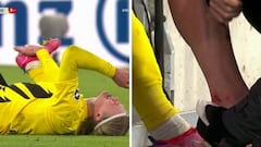 ¿Llega a la Champions? la fea lesión que sacó a Haaland del clásico