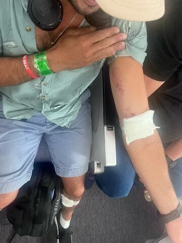 A passenger shows his injuries after an incident on a LATAM Airlines Boeing 787, in Auckland, New Zealand, March 11, 2024, in this picture obtained from social media. Brian Adam Jokat/via REUTERS  THIS IMAGE HAS BEEN SUPPLIED BY A THIRD PARTY. MANDATORY CREDIT. NO RESALES. NO ARCHIVES.