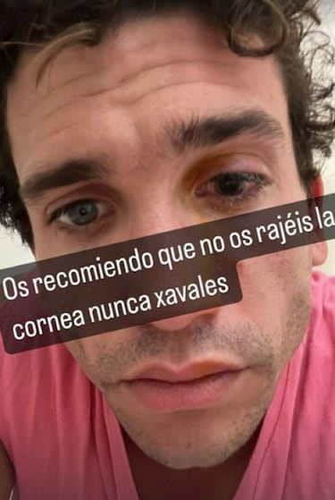 Jaime Lorente sufre un accidente laboral y se raja la c車rnea