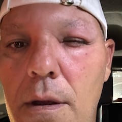 Frank Cuesta muestra la aparatosa picadura que ha sufrido de una avispa asiática