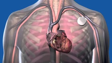 Muerte por hackeo del corazón, el problema con los dispositivos médicos inteligentes
