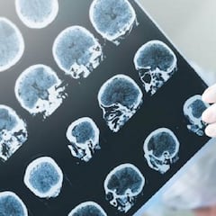 Estados Unidos aprueba el primer medicamento específico contra el Alzheimer en dos décadas