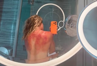 Zarazúa muestra las quemaduras del sol de Australia: “No es una broma”