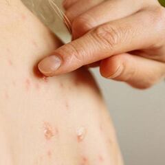 UNAM alerta por resurgimiento del brote de sarampión: qué es, síntomas y cuántos casos hay confirmados