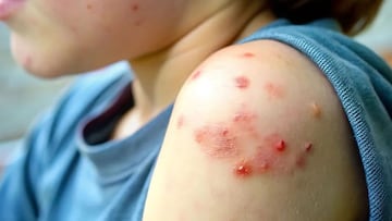 La primera muerte de sarampión del 2026 se registró en Michoacán, a nivel nacional suman 26 decesos entre 2025 y 2026.