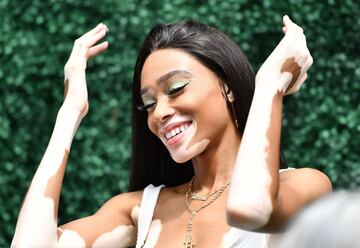 La modelo canadiense Winnie Harlow. 