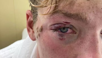 "No veía, pensé que mi ojo se había caído al agua..."