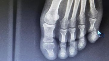 Urán se fractura un dedo del pie al tropezar con su cama