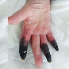 Se le vuelven negros tres dedos por el coronavirus y se los tienen que amputar