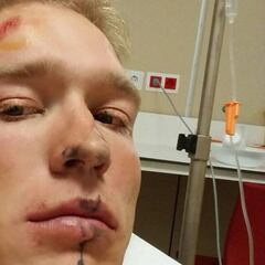 Así quedó Cort Nielsen tras fracturarse otra vez la clavícula