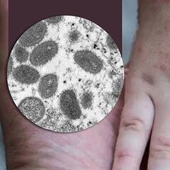 Viruela del mono en México | Casos confirmados, recomendaciones y síntomas