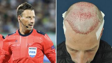 Mark Clattenburg se somete a un trasplante de cabello: "Me sentía frustrado"