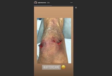 Real Madrid's Varane shows off injury picked up for own goal