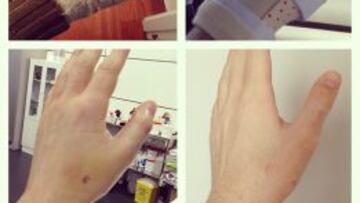 Iker Casillas muestra la evolución de su mano