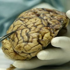 El misterioso trastorno cerebral que inquieta a Canadá
