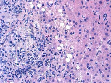 La hepatitis más grave se curará sin necesidad de transplante