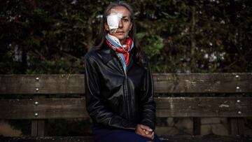 Corine Remande, la mujer que perdió la visión de su ojo derecho tras un bolazo de Brooks Koepka en la Ryder Cup, posa tras salir del hospital.